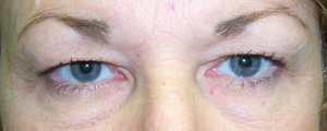 Before image of ptosis and blepharoplasty surgery, showing eyelids drooping significantly